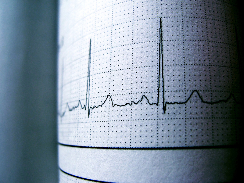 Électrocardiogramme représentant un rythme sinusal.